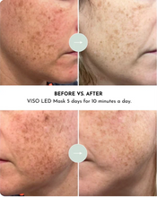 Load image into Gallery viewer, Lumara Viso Red Light Mask
